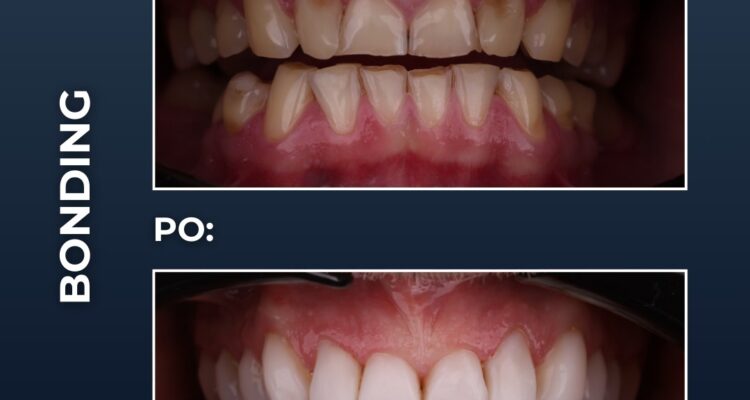 bonding tomaszów mazowiecki