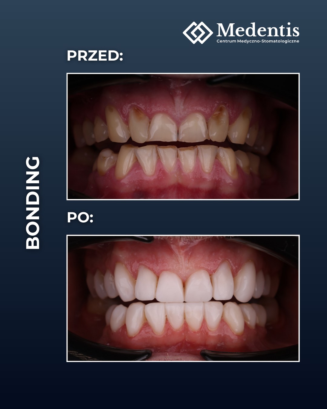 bonding tomaszów mazowiecki